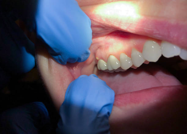Best Emergency Root Canal Treatment in Manassas, VA